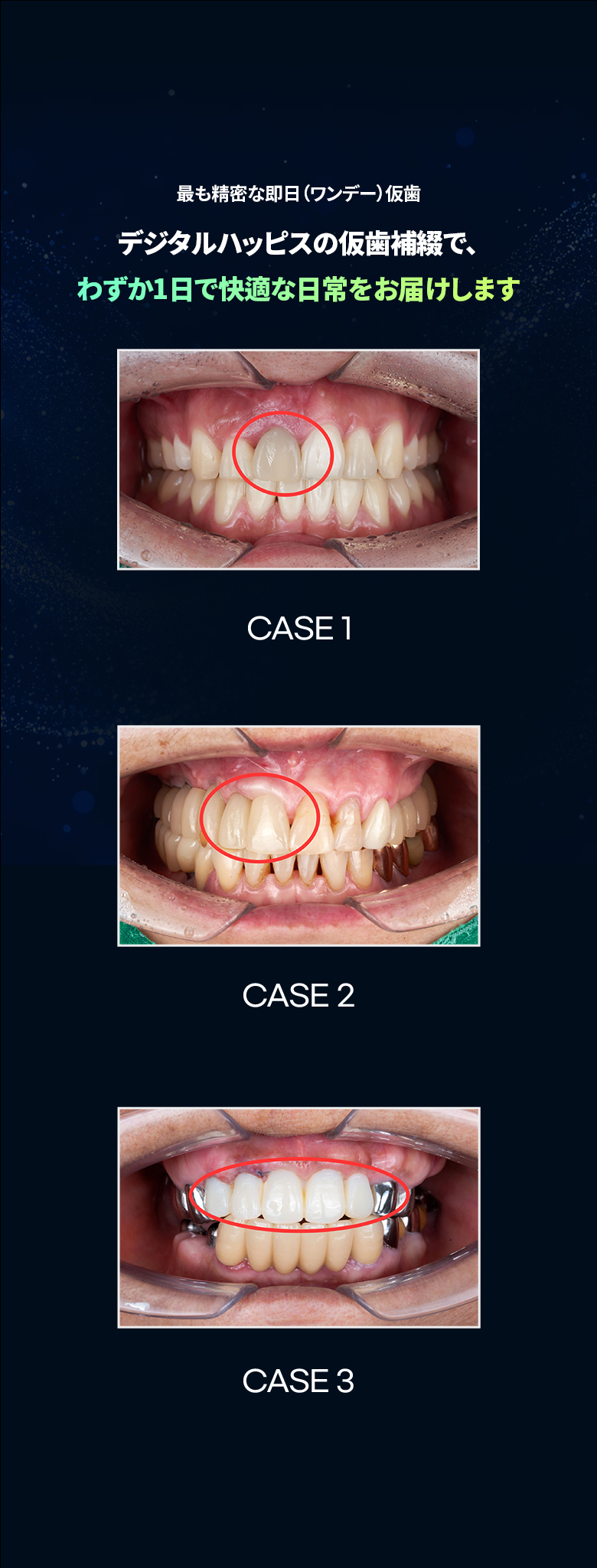 当日仮歯の説明とCASE 1〜3の口腔内写真