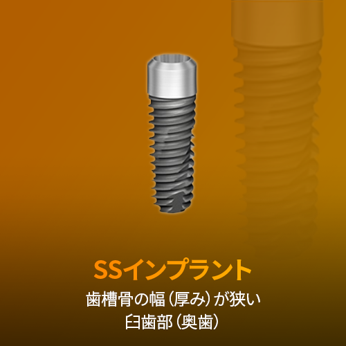 SSインプラント:歯槽骨の幅(厚み)が狭い臼歯部(奥歯)用