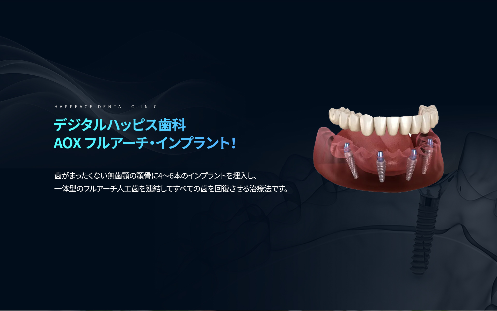 AOXフルアーチ・インプラント:無歯顎に4〜6本を埋入